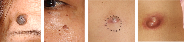 皮膚のできもの・腫瘍