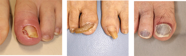 手・足・爪のトラブル